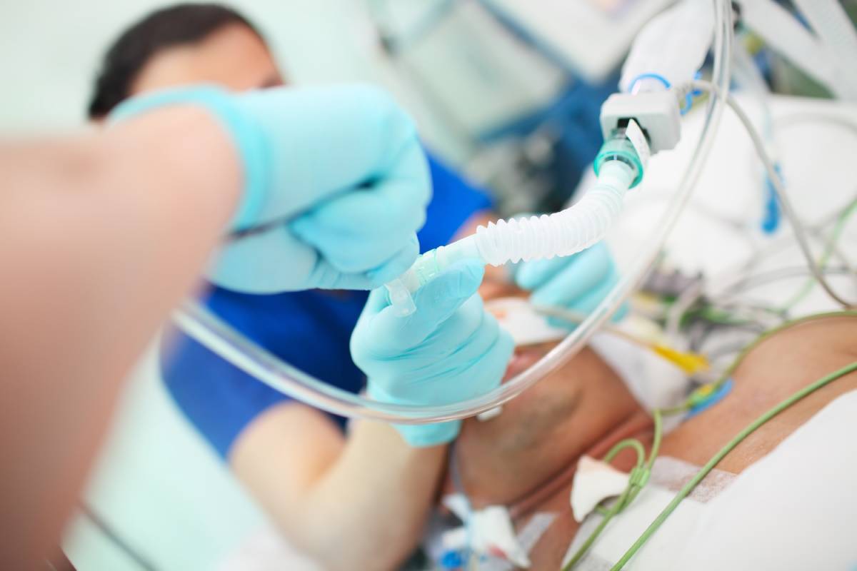 Using Esophageal Pressure to Improve Mechanical Ventilation