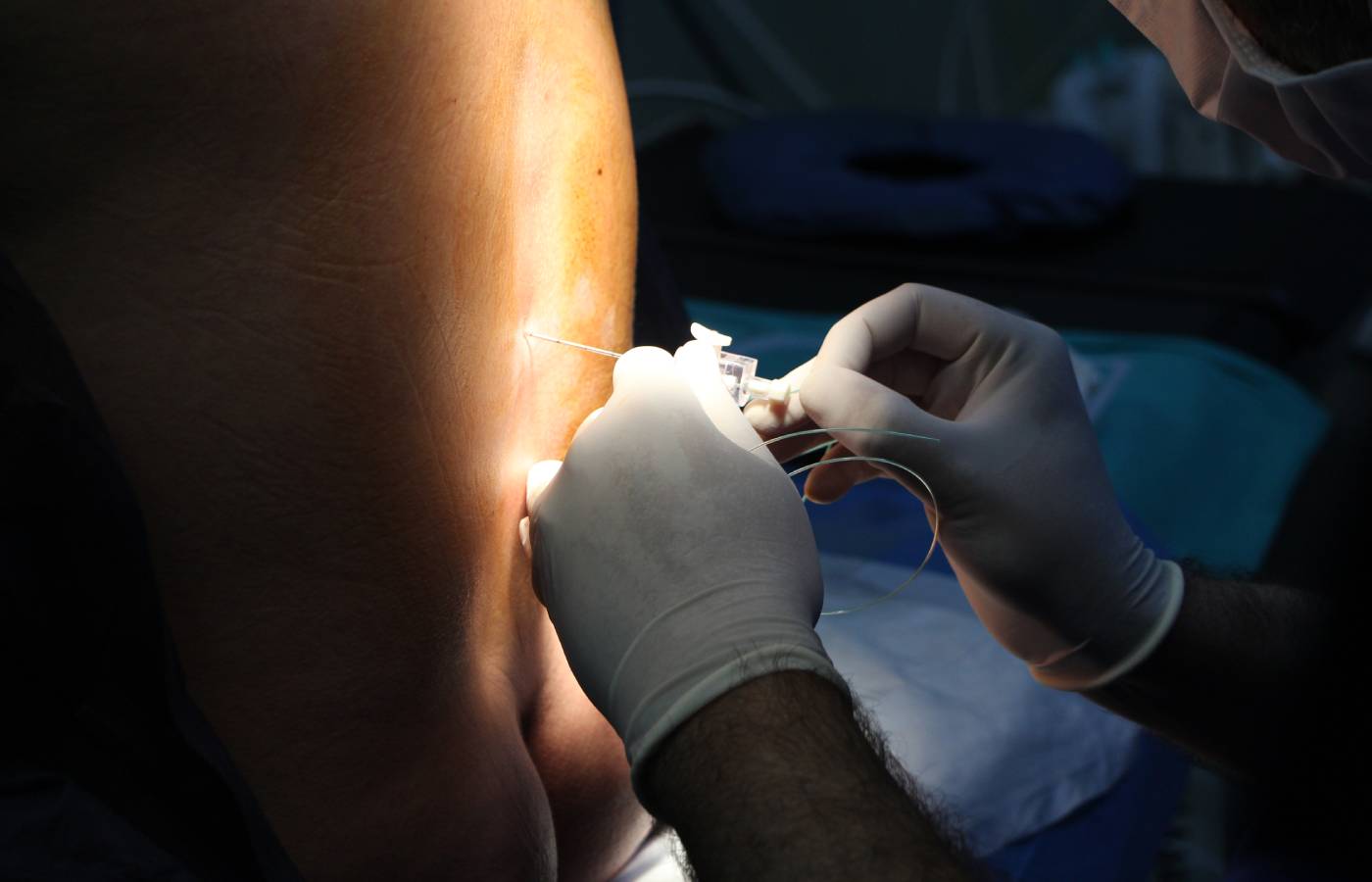 Regional Anesthesia for Hip Surgery