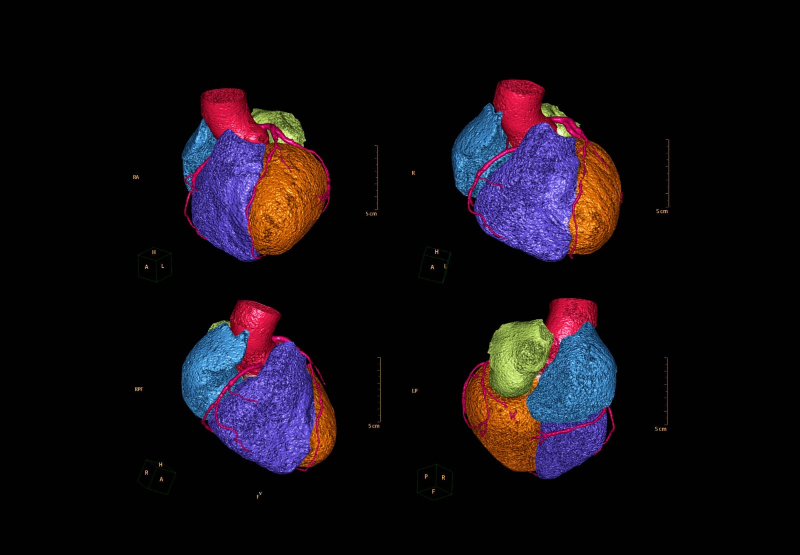Anesthesia Considerations for Patients with Myocardial Ischemia