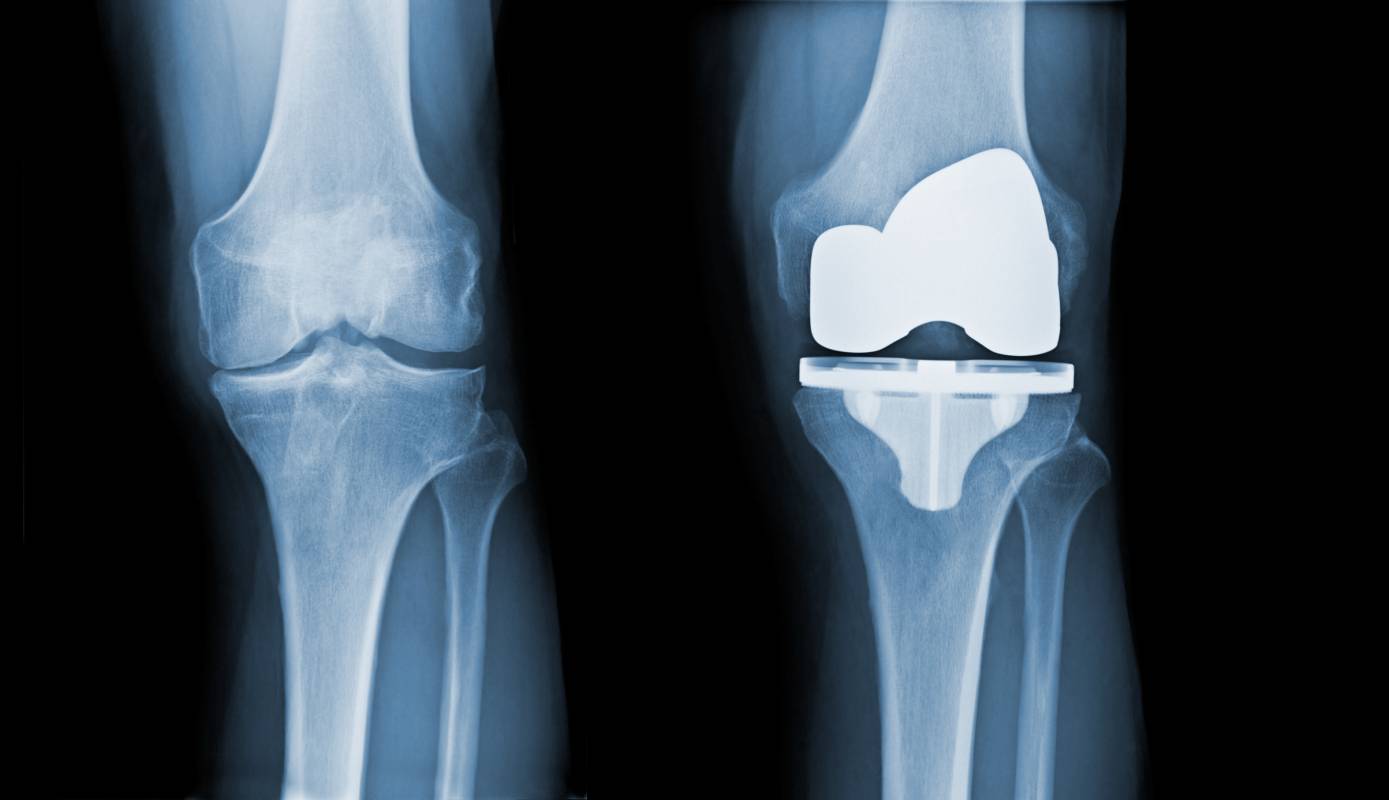 Total Joint Replacements in Young Adults