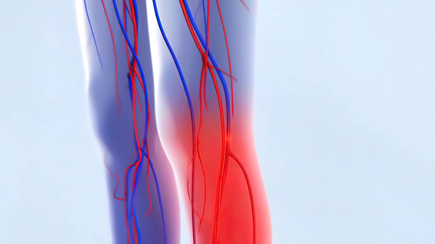 Reducing Risk of Clots After Surgery