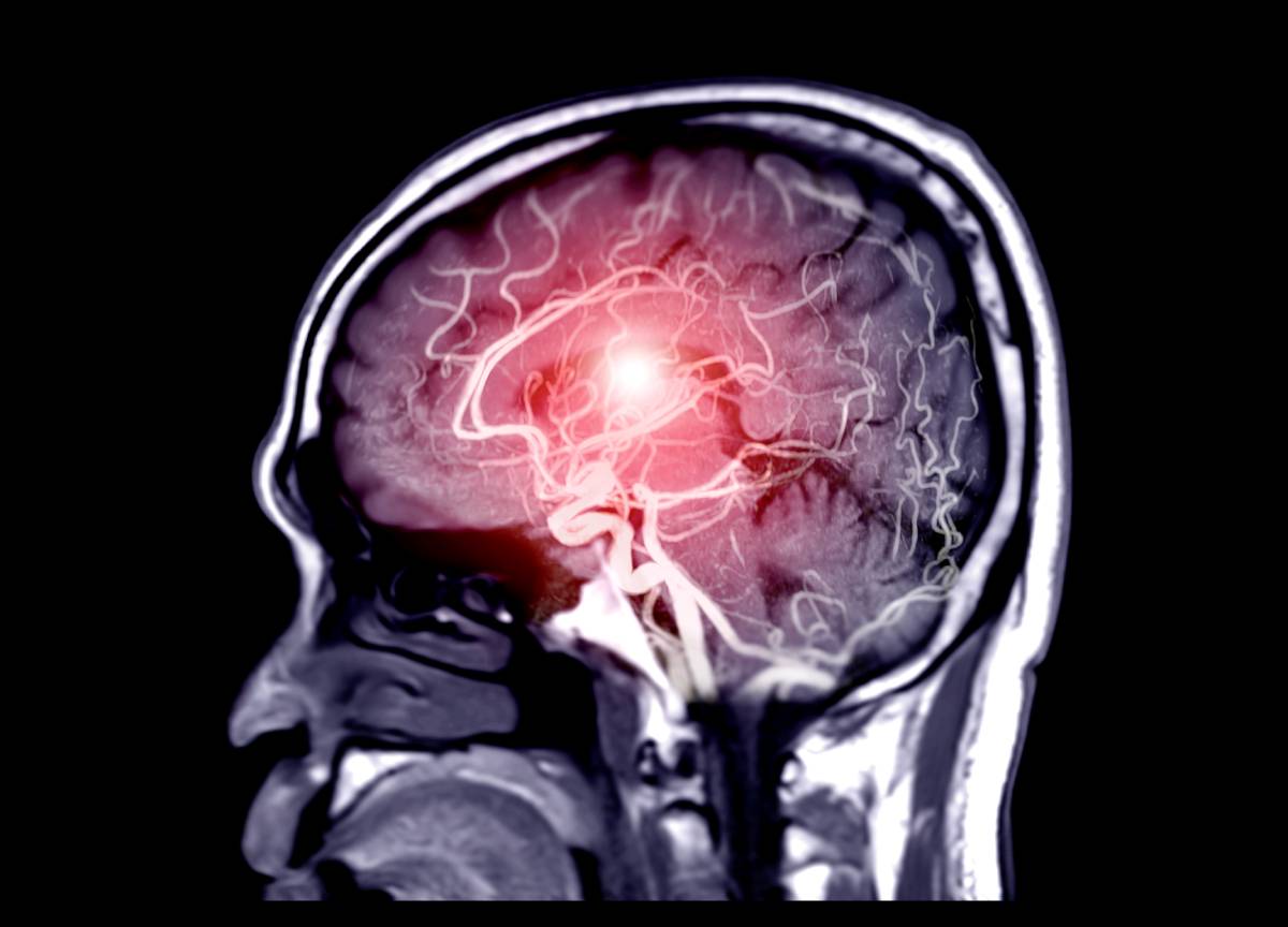 Acute ischemic stroke occurs because of decreased blood flow to the brain.