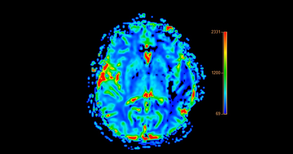 Postoperative Cognitive Dysfunction and Reduced Intraoperative Cerebral Perfusion
